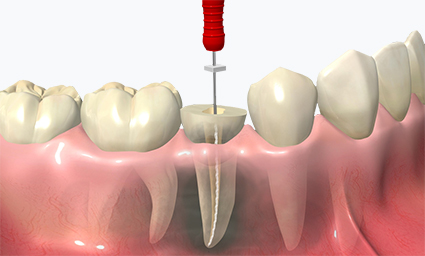 Endodoncia