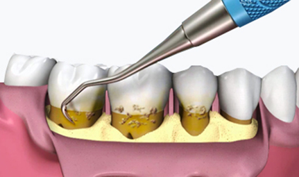 Periodoncia